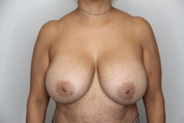 Case--3976 | Before Breast Implant Removal 1