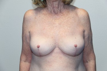 Case--2578 | After Breast Implant Removal 1