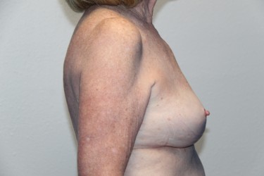 Case--2578 | After Breast Implant Removal 2