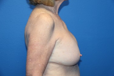 Case--2578 | Before Breast Implant Removal 2