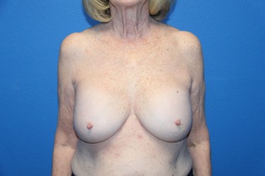 Case--2578 | Before Breast Implant Removal 1