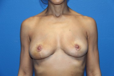 Case--3248 | After Breast Implant Removal 1