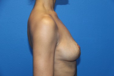 Case--3248 | After Breast Implant Removal 2