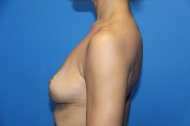 Case--3248 | After Breast Implant Removal 3