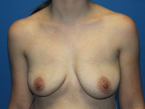 Case--7107 | After Breast Implant Removal 1
