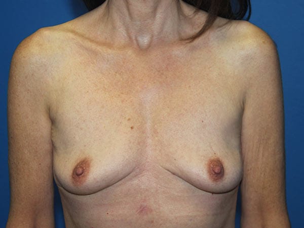 Case--7580 | After Breast Implant Removal 1