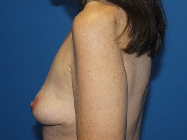 Case--7580 | After Breast Implant Removal 2