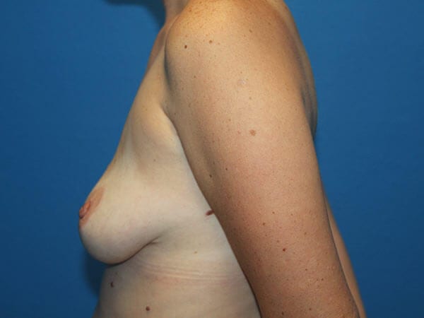 Case--7949 | After Breast Implant Removal 2