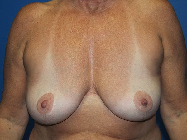 Case--5604 | After Breast Implant Removal 1