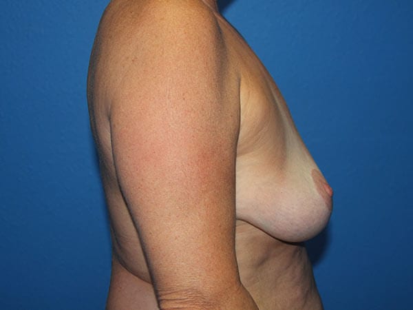 Case--5604 | After Breast Implant Removal 2