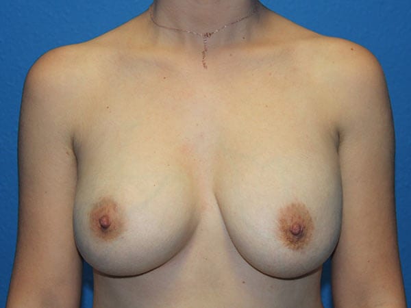 Case--7107 | Before Breast Implant Removal 1