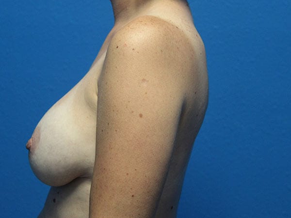Case--7949 | Before Breast Implant Removal 2