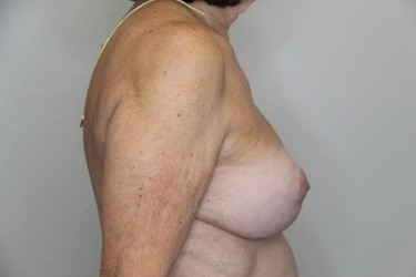 Case--8991 | After Breast Implant Repair 2