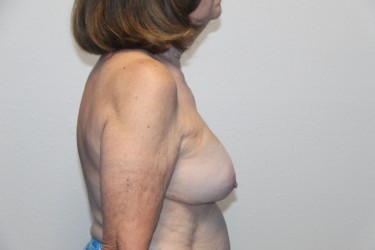Case--8991 | Before Breast Implant Repair 2