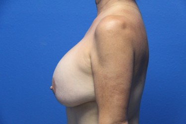 Case--1485 | Before Breast Implant Repair 3