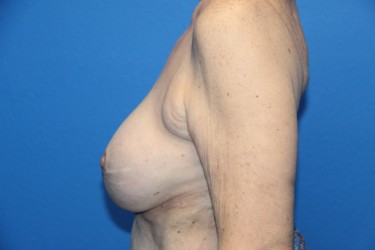 Case--2975 | After Breast Implant Repair 2