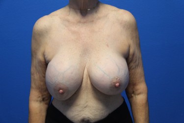 Case--2975 | Before Breast Implant Repair 1
