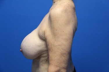Case--2975 | Before Breast Implant Repair 2