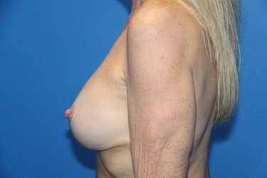 Case--3750 | After Breast Implant Repair 3