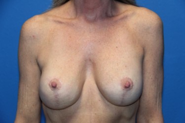 Case--3750 | After Breast Implant Repair 1