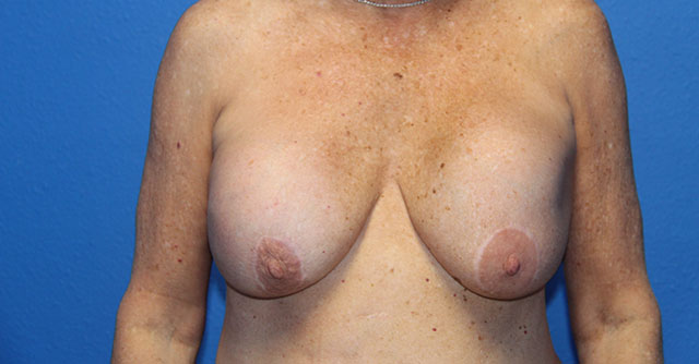 Case--8247 | Before Breast Lift with Augmentation 1
