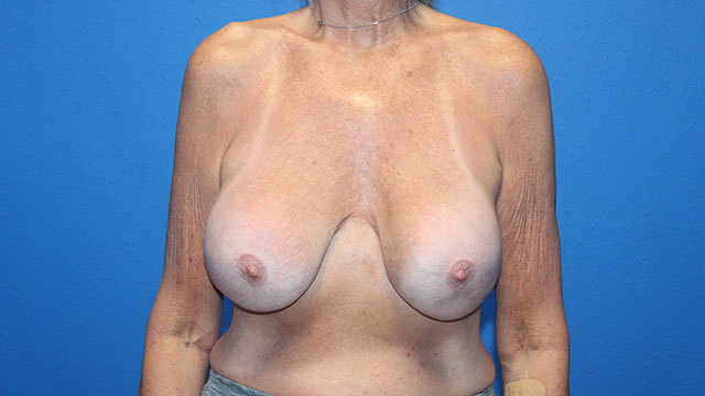 Case--1494 | Before Breast Lift with Augmentation 1