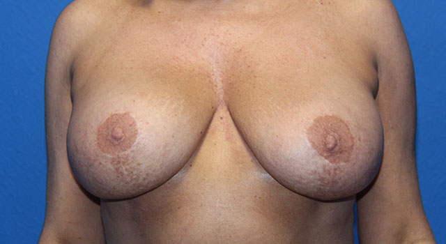 Case--3971 | After Breast Lift with Augmentation 1