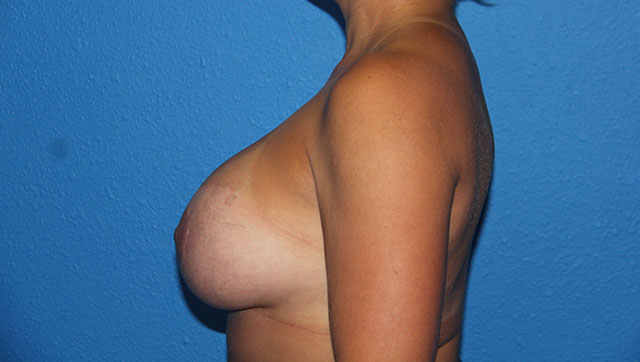 Case--4736 | After Breast Lift with Augmentation 2