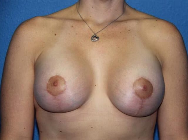 Case--1895 | After Breast Lift with Augmentation 1