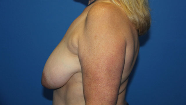 Case--9581 | Before Breast Lift 4