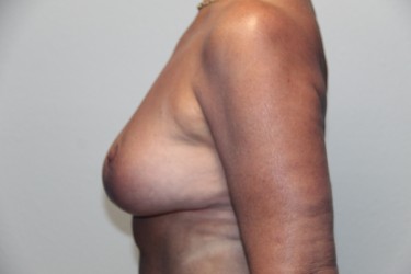 Case--1028 | After Breast Reduction 2