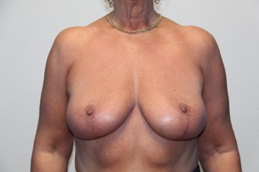 Case--1028 | After Breast Reduction 1