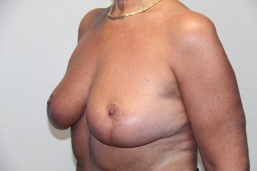 Case--1028 | After Breast Reduction 3