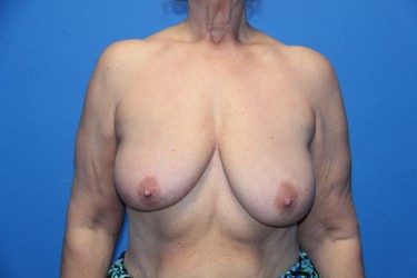 Case--1028 | Before Breast Reduction 1