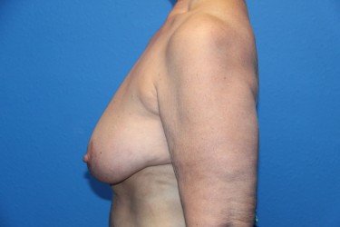 Case--1028 | Before Breast Reduction 2
