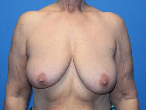 Case--9299 | Before Breast Reduction 1
