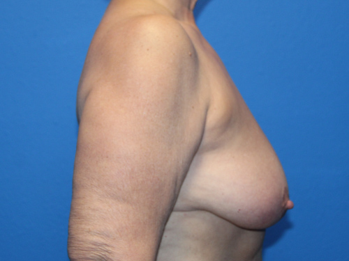 Case--9299 | Before Breast Reduction 2