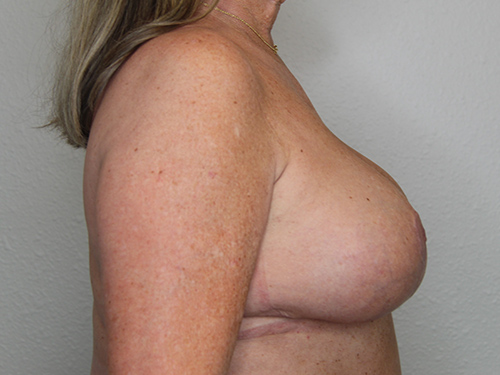 Case--7576 | After Breast Reduction 2