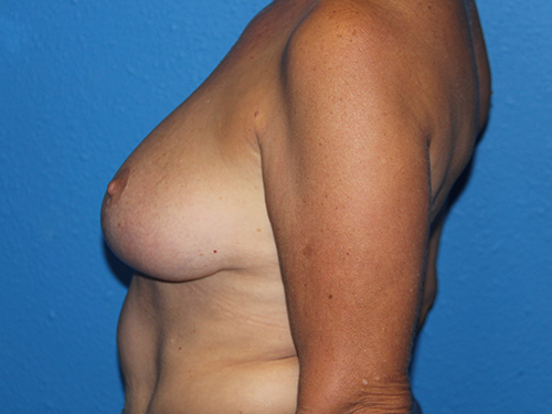 Case--3802 | After Breast Reduction 1