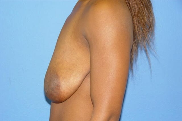 Case--9822 | Before Breast Reduction 2