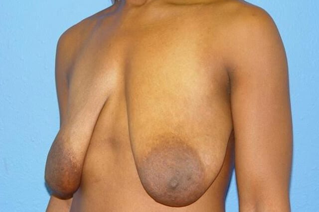 Case--9822 | Before Breast Reduction 1