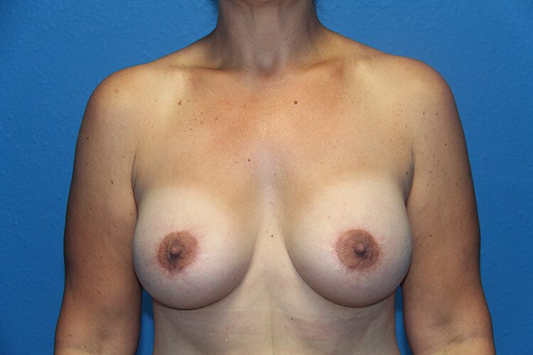 Case--7300 | After Breast Augmentation 1