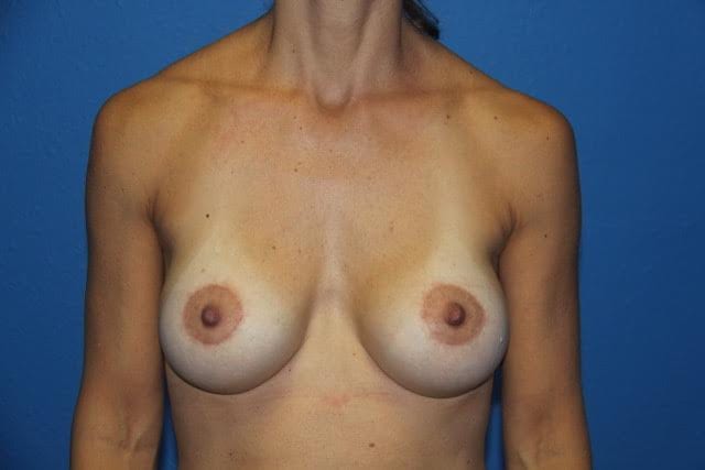 Case--8456 | After Breast Lift with Augmentation 1