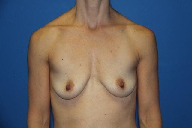 Case--8456 | Before Breast Lift with Augmentation 1