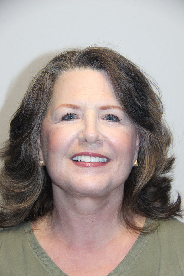 Case--3840 | After Eyelid Surgery / Blepharoplasty 1
