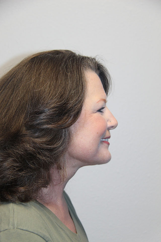 Case--3840 | After Eyelid Surgery / Blepharoplasty 3