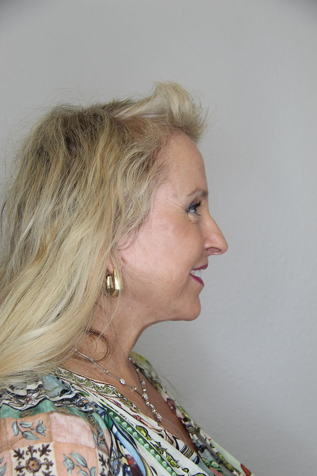 Case--6812 | After Eyelid Surgery / Blepharoplasty 2