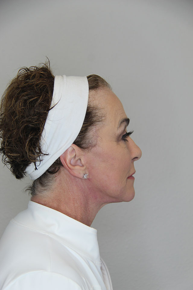 Case--7146 | After Fat Injection to the Face 3