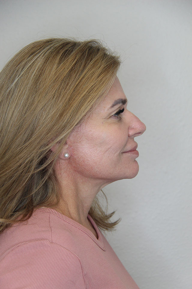 Case--6127 | After Cheek Lift 2