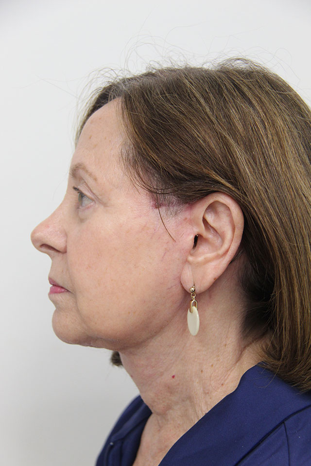 Case--2520 | After Eyelid Surgery / Blepharoplasty 2
